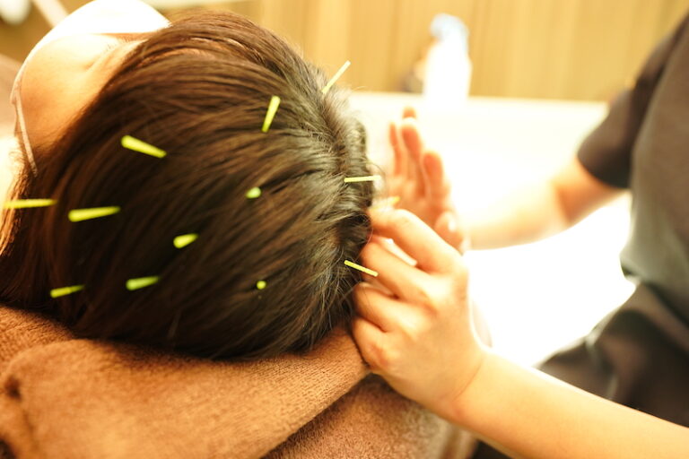 鍼灸による頭髪治療について